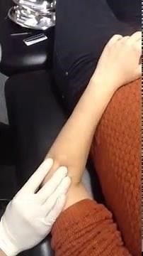 Extensor Digitorum Dry Needling