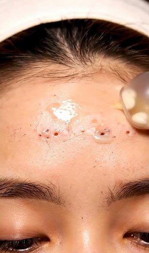 Forehead Line Suction ASMR — Deep Blackhead & Sebum Extraction #asmr #skincare