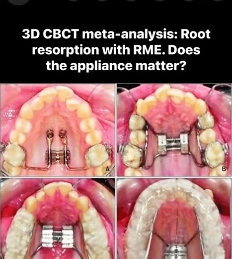 3D CBCT meta-analysis: Root resorption with RME. Does the appliance matter? The Orthod Craniofac Res journal published a paper submitted by Dr Xue and team in 2026. What did they do? Systematic review & meta-analysis comparing root resorption after rapid maxillary expansion using 3D CBCT volumetric measurements. Searches across 7 databases up to Dec 2024. Included 16 studies (525 patients; 2,906 teeth), mainly RCTs and observational comparisons of tooth-borne vs bone-borne (and some hybrid) expa