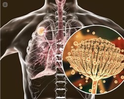 Quiz de Aspergilosis