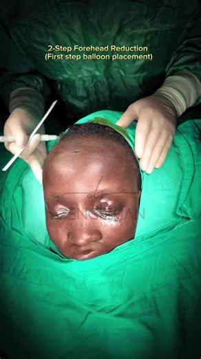 Forehead Reduction Surgery: 2-Step Process Explained