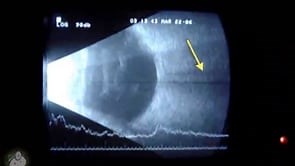 Ultrasound of the eye (Video) - TimRoot.com