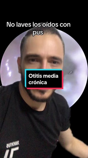 Chronic Otitis Media: Causes, Symptoms, and Treatment