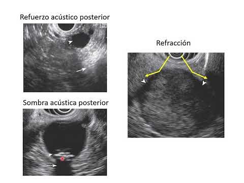 Principios básicos de la ultrasonografía. Tipos de ecoendoscopios.
