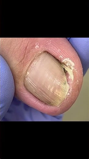 Ingrown Toenail Trimming - Professional Pedicure #satisfying#foot