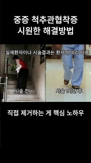 Severe Spinal Stenosis in 15 Minutes Without Surgery! The 'Foramen Decompression' That Amazed the...