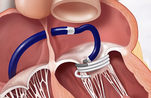 The Edwards Lifesciences Sapien M3 transcatheter mitral valve replacement system uses nitinol in a new way