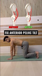 Fix Anterior Pelvic Tilt|#shorts