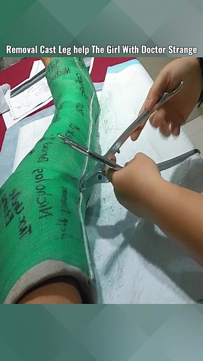 Watch The Doctor Helps The Woman Removal Cast Broken Leg 😱 #castremoval #removal #fypage #emotional #doctorstrange #hospital #brokenleg #cutting #removalvideo #doctorstrange
