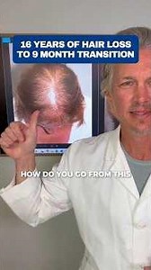 Why You Are Still Losing Hair After Years of Treatment