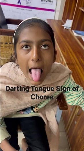 Darting Tongue Sign of Chorea #Rheumatic #Chorea #shorts #neurology #sydenham 🧠