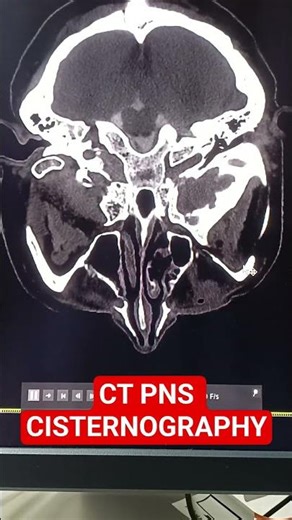 CT PNS CISTERNOGRAPHY#anatomy#ctsca#medicalimaging#humananatomy#radiographer#science#ctscanning