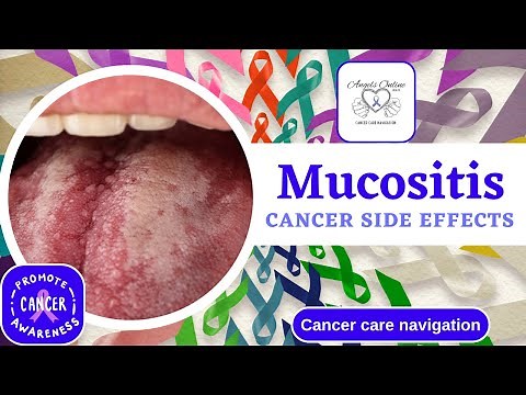 Understanding Mucositis: A Side Effect from Cancer Treatment | Symptoms, Management, & Home Remedies