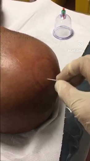 PERFORMING Hijama on the HEAD for CHRONIC MIGRAINE