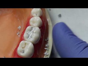 #30 Occlusal Amalgam Filling - Dr. James Keddington (UofU SOD)