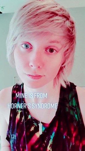 Exploring Heterochromia: Unique Eye Conditions Revealed