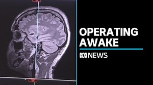 Successful brain surgery performed on patient required to be fully awake for procedure