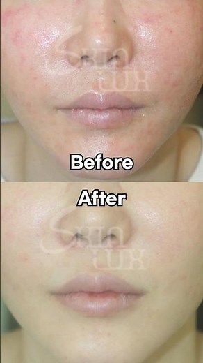 How I Escaped Rosacea and Facial Flushing After Giving Up on Using Steroids, Antibiotics, and Soo...