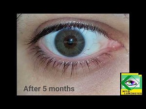 laser eye color change surgery