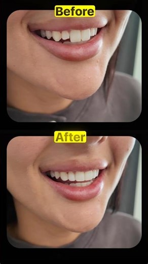 Composite edge bonding can really fix up the edges of your teeth so they look perfect and natural!