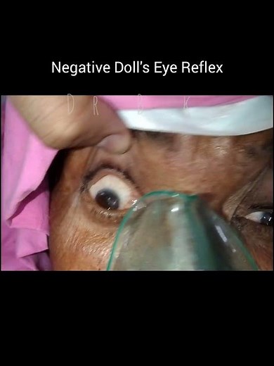 Doll's Eye Reflex By Dr Bilal khanzada