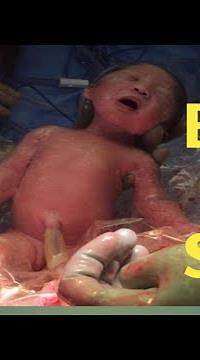 Preemie baby Born at 33 weeks