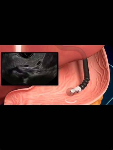 Endoscopic ultrasound scans explained!!! #endoscopicultrasound #guidedultrasound #sonographyguided #radiologymap #signsexplained