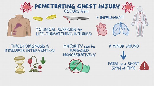 Video: Approach to penetrating chest injury: Clinical sciences - Video Explanation! | Osmosis | Osmosis