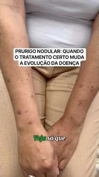 Prurigo nodular