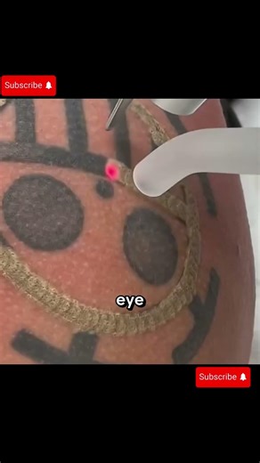 How Laser Tattoo Removal ACTUALLY Works 🤯
