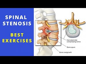 Spinal Stenosis daily exercises for pain relief