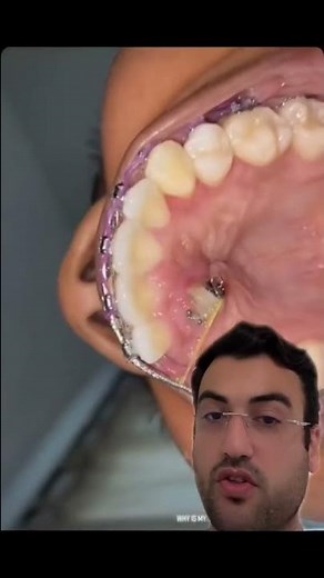 DENTISTA explica DENTE NO CÉU DA BOCA!