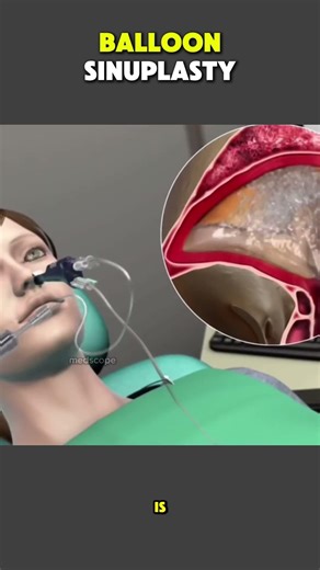 How Balloon Cynoplasty Is Done | Minimally Invasive Sinus Treatment #BalloonCynoplasty