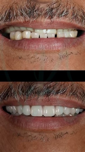 Dental Works | High-impact dentures are made with reinforced acrylic that is: ✔ Stronger than regular dentures ✔ More fracture-resistant ✔ Lightweight... | Instagram