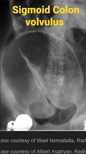 sigmoid colon volvulus #radiology #emergency #abdominal #pain. #enema #surgery
