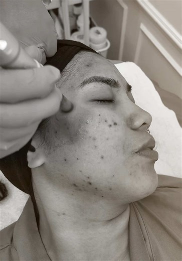 Pagod na ang burog kong fez. Concealer, we’ve had good times… but this year, I’m going au naturel 😆✨ Time to get help from @beautycoutureclinc 💗 #Skincare #PDRN #VampireFacial #BeautyCouture #Facial