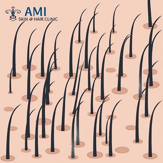 GFC Hair procedure | Hair Loss | Hair fall treatment | Ami Skin Hair Clinic