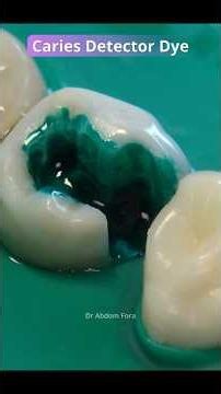 The green liquid is: Caries Detector Dye (CDD)