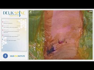 C6-C7 NECK PAIN - LIVE - Laser Spine Surgery