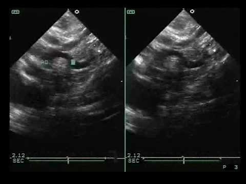 Echocardiography of Interrupted Aortic Arch