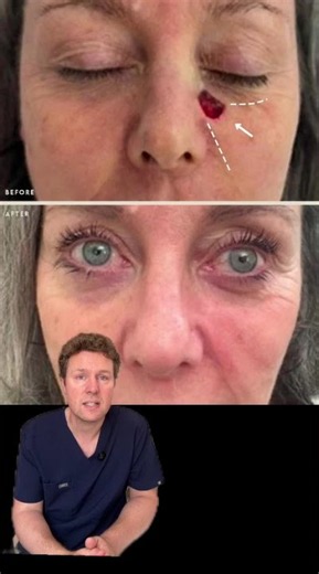 Removal of Basal Cell Carcinoma using Mohs surgery