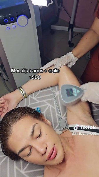 Mesolipo Arms Exilis for Instant Results