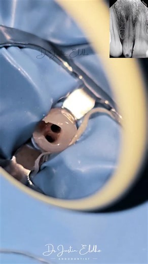 Dr Justin Eldho on Instagram: "Endodontic Management of a Maxillary Lateral Incisor with Oehlers Type II Dens Invaginatus from Consultation Case Series. CBCT Assisted Endodontics. Access Opening under loupes. Main canal - Shaping 35.06% - Torque Endo Blue @dcaredentals Cleaning 3% Naocl + 17% EDTA + Sonic Activation . Invagination Cleaned and sealed with MTA. Obturation- Bioactive RCS @safeendoindia Dens Invaginatus (Dens in Dente) is a developmental anomaly resulting from invagination of the en
