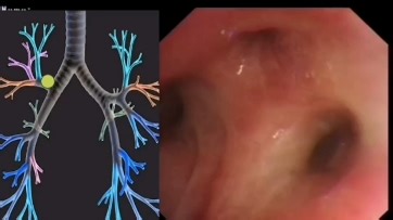 高清易懂支气管镜操作视频，带讲解。