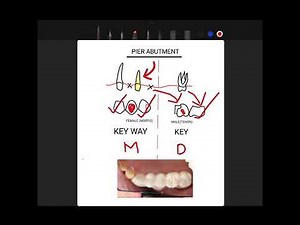 “Pier Abutment & Key/Keyway in Dental Bridges | Complete 5-Minute Guide”