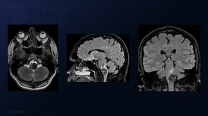 #401: Far Lateral Craniotomy for Resection of an Olivary Medullary Cavernous Malformation - All Videos - Seven Series Collection