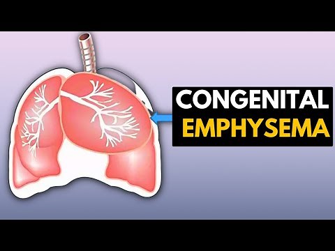 Beyond the Surface: Exploring Congenital Emphysema and Its Hidden Effects