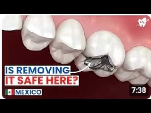 Amalgam Removal Procedure in Puerto Vallarta