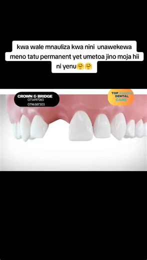 Understanding Dental Bridges: Why Three Teeth?