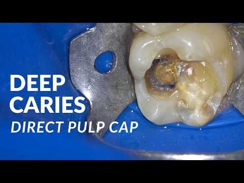 Deep Caries Management with Direct Pulp Capping & Composite Restoration | Step-by-Step Clinical Case